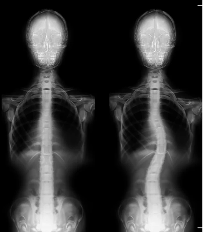 Scoliosis Treatment In Pantego